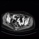 Uterus, mimics a presacrall mass, extirpation of anus: CT - Computed tomography